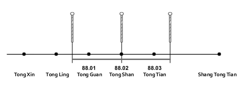 Needling an Undefined Point Illustration 10: Needling an Undefined Point