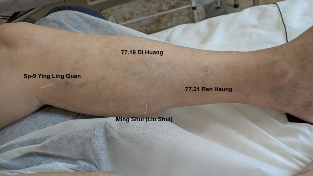 Managing Hot Flashes With Master Tung's Acupuncture Points located in the kidney area of the leg