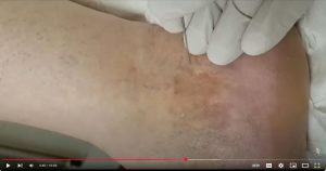 Ankle Sprain