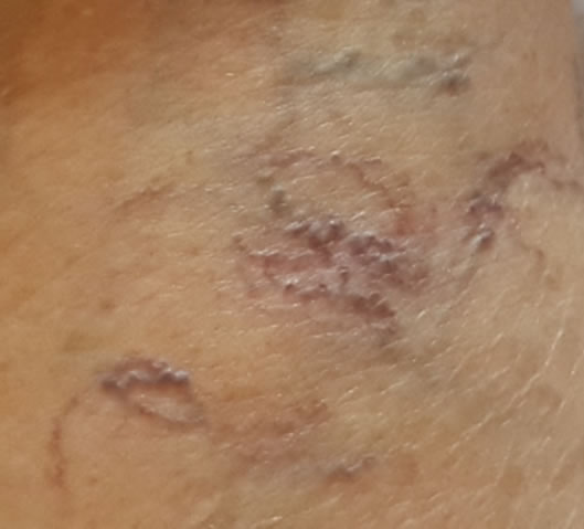 Bloodleting spider angiomas Bloodleting spider angiomas